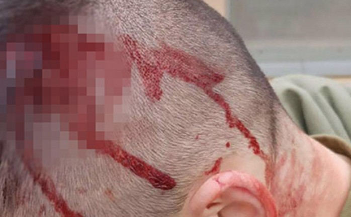 أحد الجنود المصابين خلال الشجار في القاعدة العسكرية بالنقب